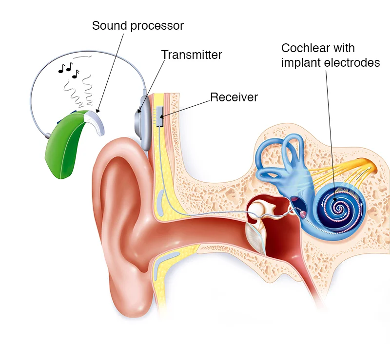 Cochlear Implant Surgery